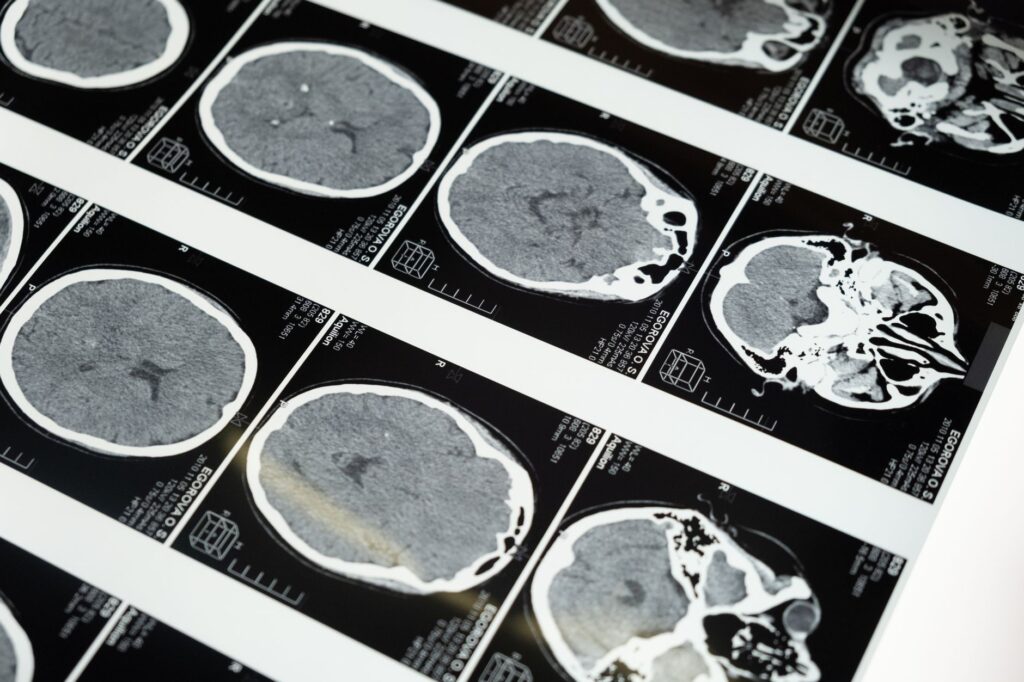Detailed brain MRI scans displayed on a lightbox, showcasing medical imaging techniques, an image for Religious Experience: Can Neuroscience Explain It